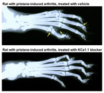 Rheumatoid Arthritis and Biophysics