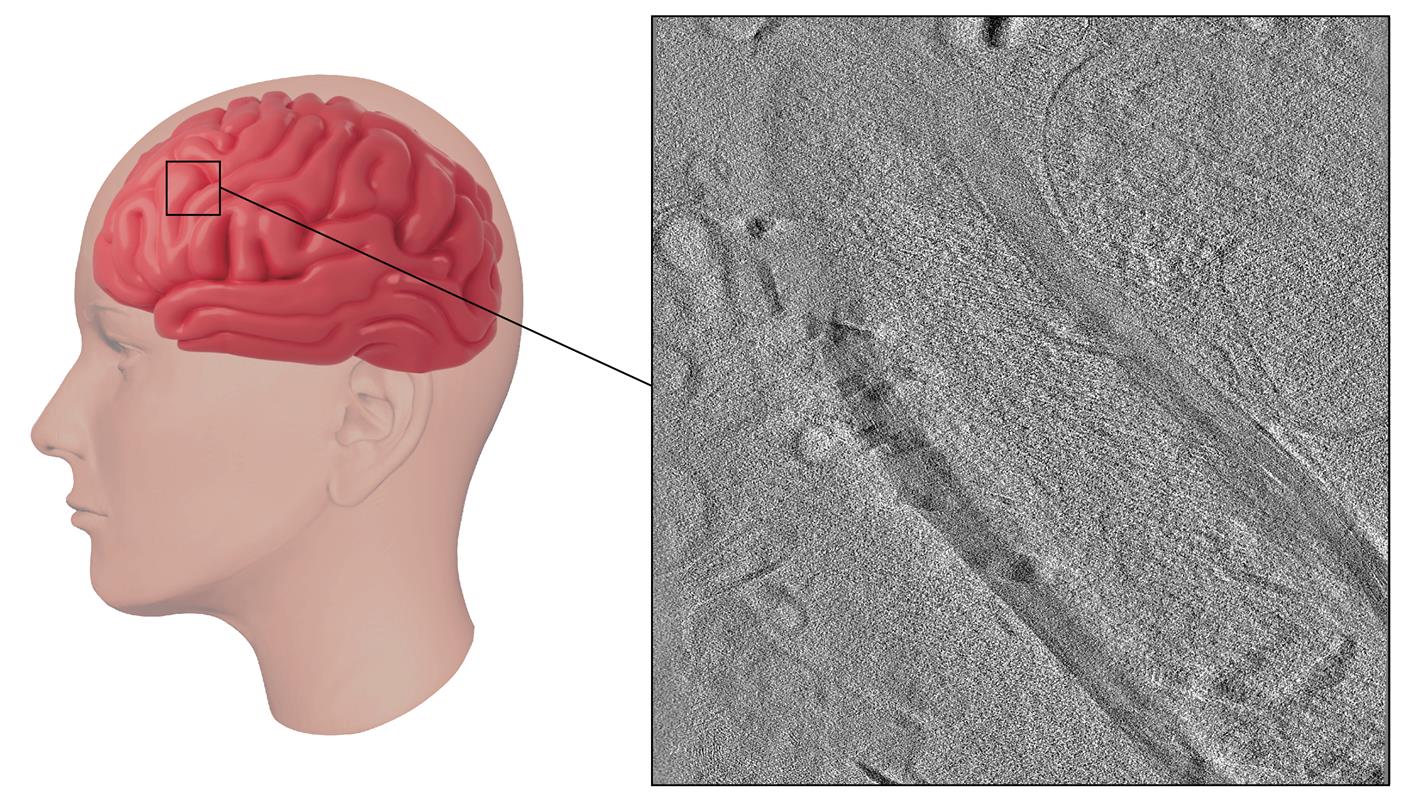 Using Ion Beams to Improve Brain Microscopy